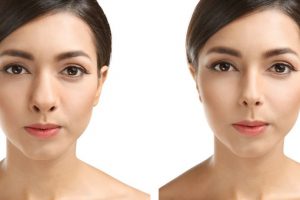 Nâng mũi cấu trúc 3D Structureform Total RhinoPlasty