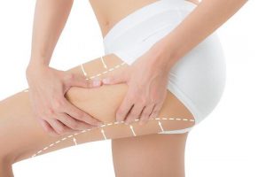 Hút mỡ đùi Thigh Liposuction